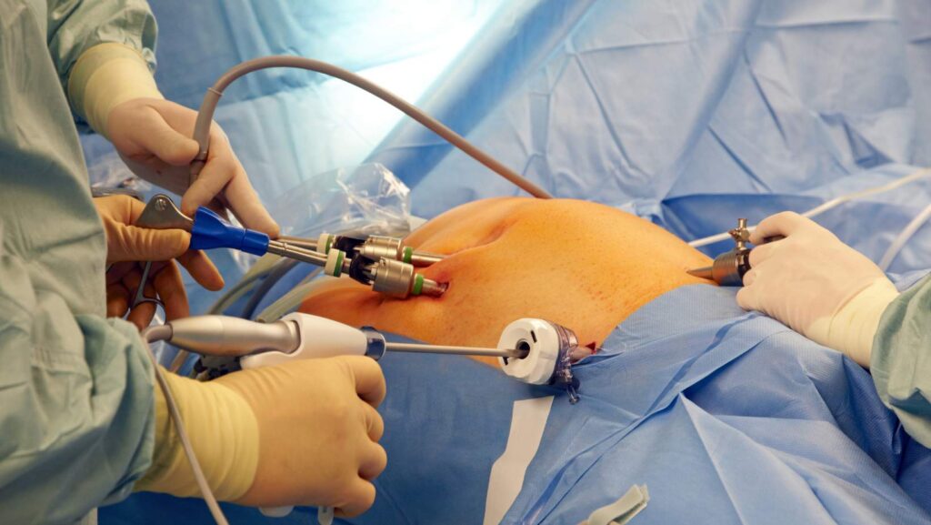 Innovacion-en-tecnicas-laparoscopicas:-recuperacion-mas-rapida-y-comoda